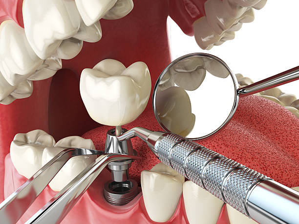 Best Broken or Chipped Tooth Repair in Panacea, FL